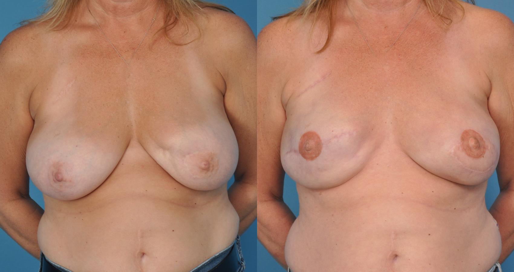 Before & After Breast Reconstruction with Latissimus Flaps Case 30 View #1 View in North Shore, IL