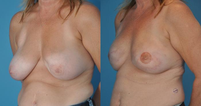 Before & After Breast Reconstruction with Latissimus Flaps Case 30 View #2 View in North Shore, IL