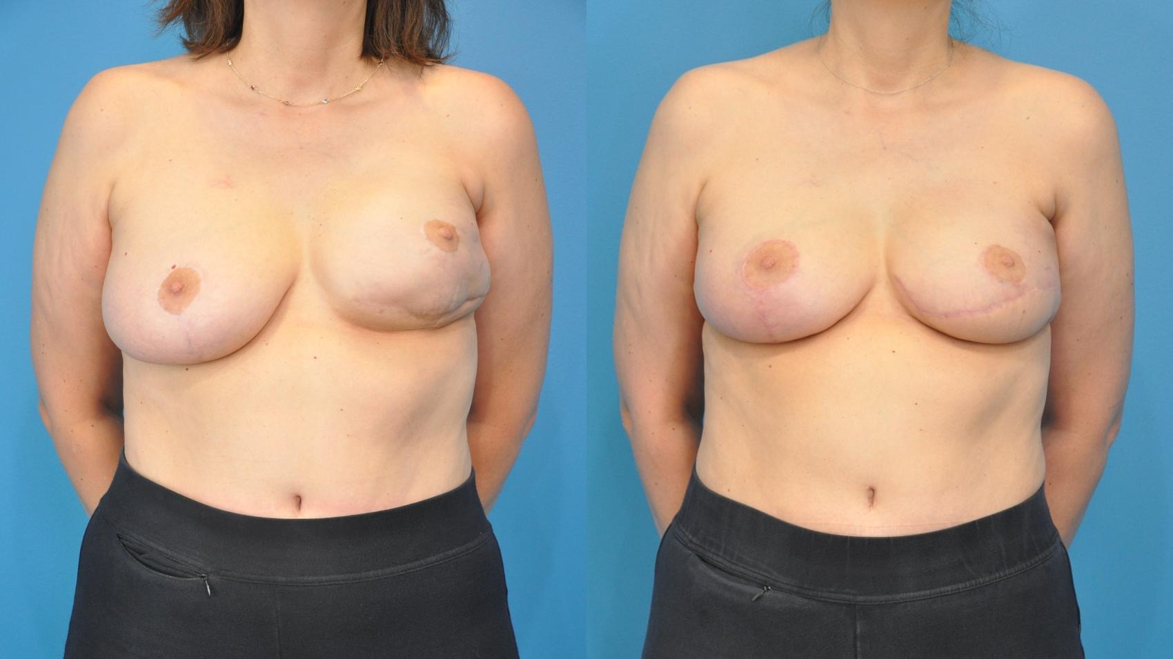 Before & After Breast Reconstruction with Latissimus Flaps Case 348 Front View in North Shore, IL