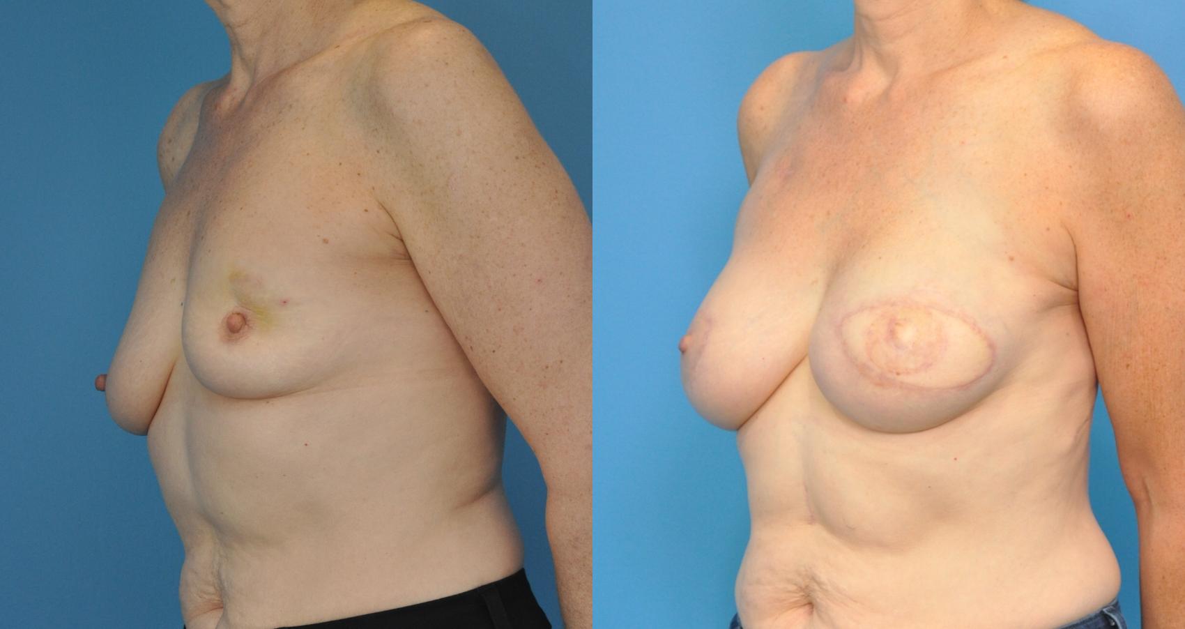 Before & After Breast Reconstruction with Latissimus Flaps Case 53 View #1 View in Northbrook, IL