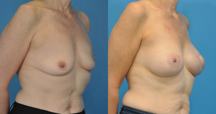Before & After Breast Reconstruction with Latissimus Flaps Case 53 View #2 View in North Shore, IL