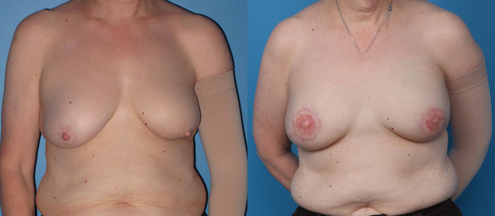 Before & After Breast Reconstruction with Latissimus Flaps Case 73 View #1 View in Northbrook, IL