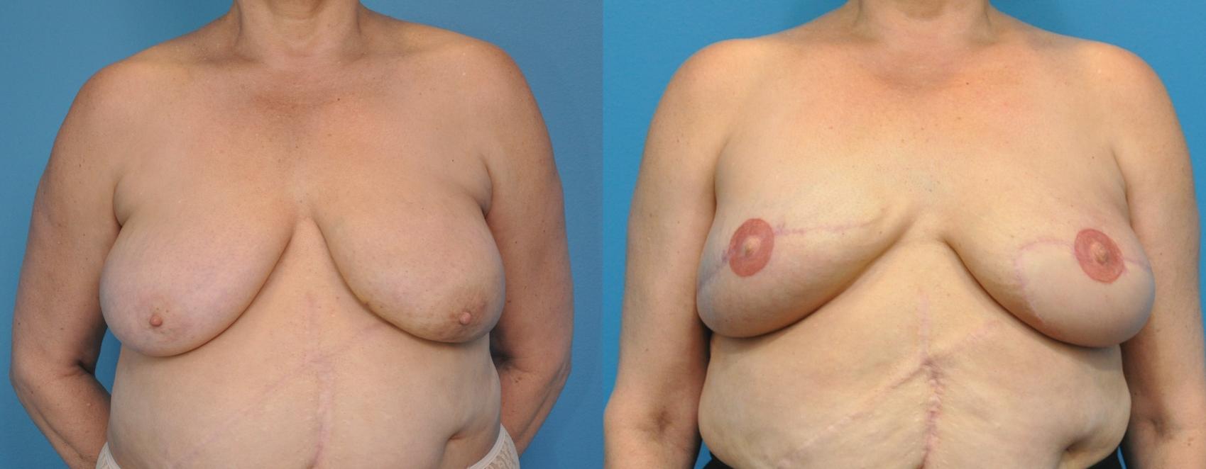 Before & After Breast Reconstruction with Latissimus Flaps Case 77 View #1 View in Northbrook, IL