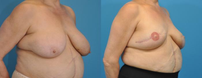 Before & After Breast Reconstruction with Latissimus Flaps Case 77 View #2 View in North Shore, IL