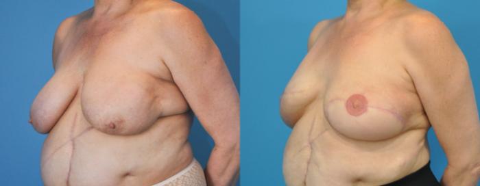 Before & After Breast Reconstruction with Latissimus Flaps Case 77 View #3 View in North Shore, IL