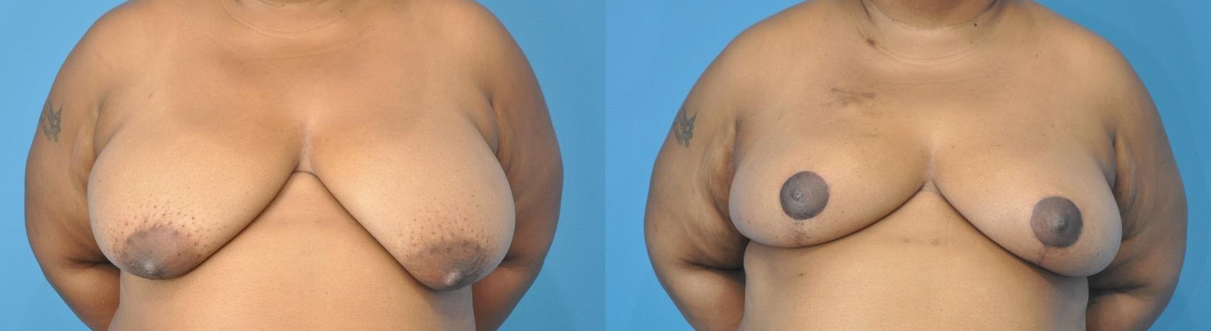 Before & After Breast Reduction Case 120 View #1 View in North Shore, IL
