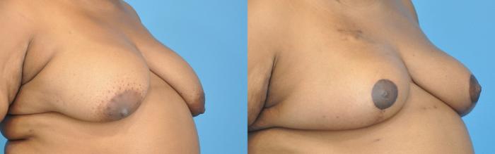 Before & After Breast Reduction Case 120 View #2 View in North Shore, IL
