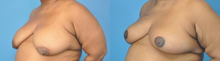 Before & After Breast Reduction Case 120 View #3 View in North Shore, IL