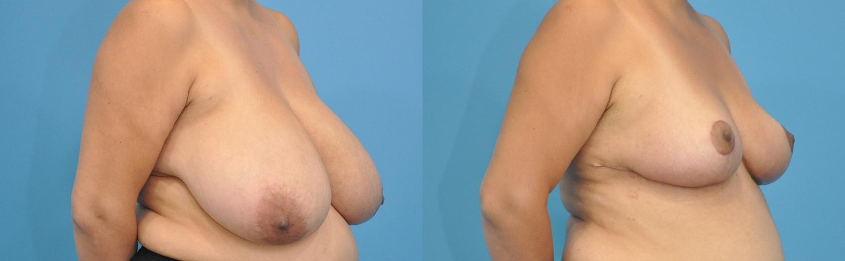 Before & After Breast Reduction Case 131 View #1 View in North Shore, IL