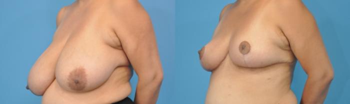 Before & After Breast Reduction Case 131 View #2 View in North Shore, IL