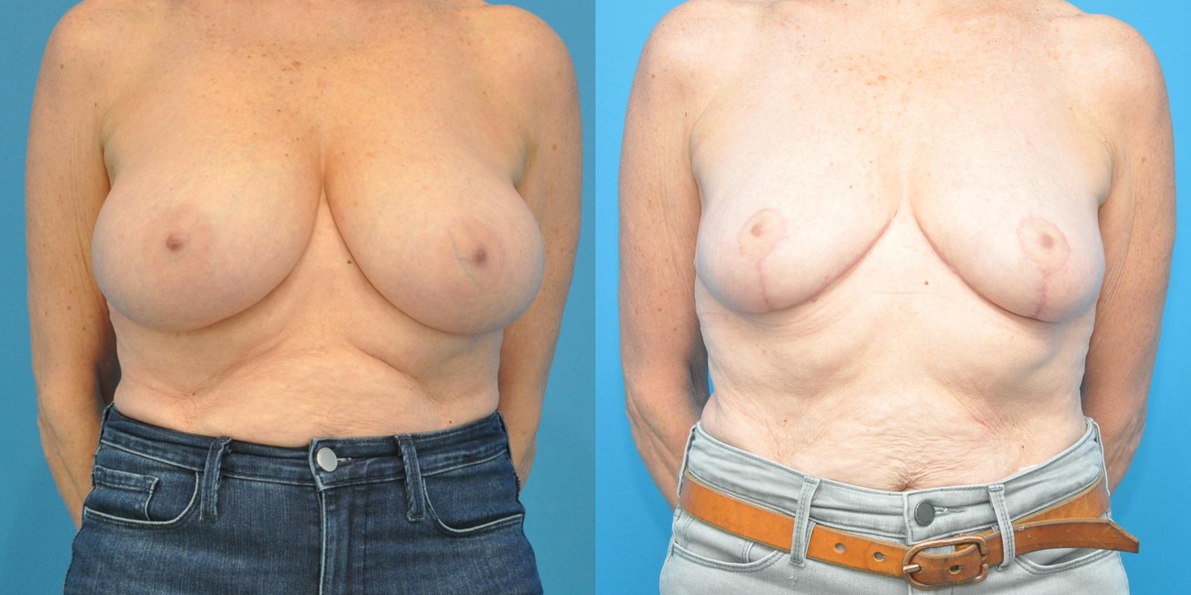 Before & After Breast Reduction Case 147 View #1 View in Northbrook, IL