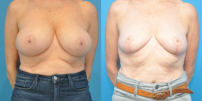 Before & After Breast Reduction Case 147 View #1 View in North Shore, IL