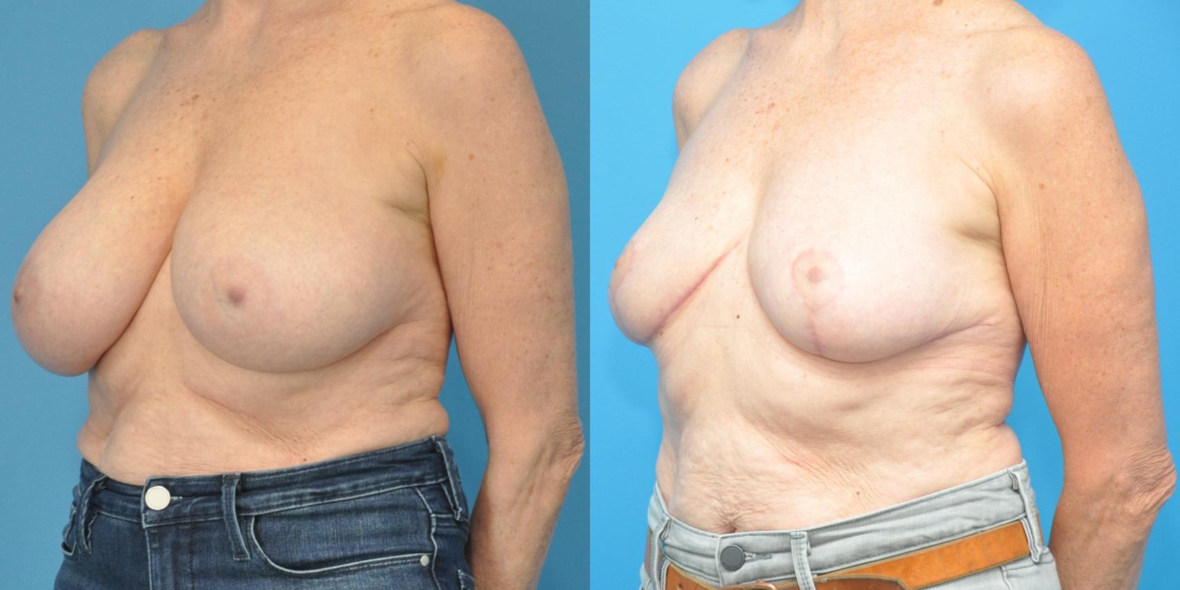 Before & After Breast Reduction Case 147 View #2 View in Northbrook, IL