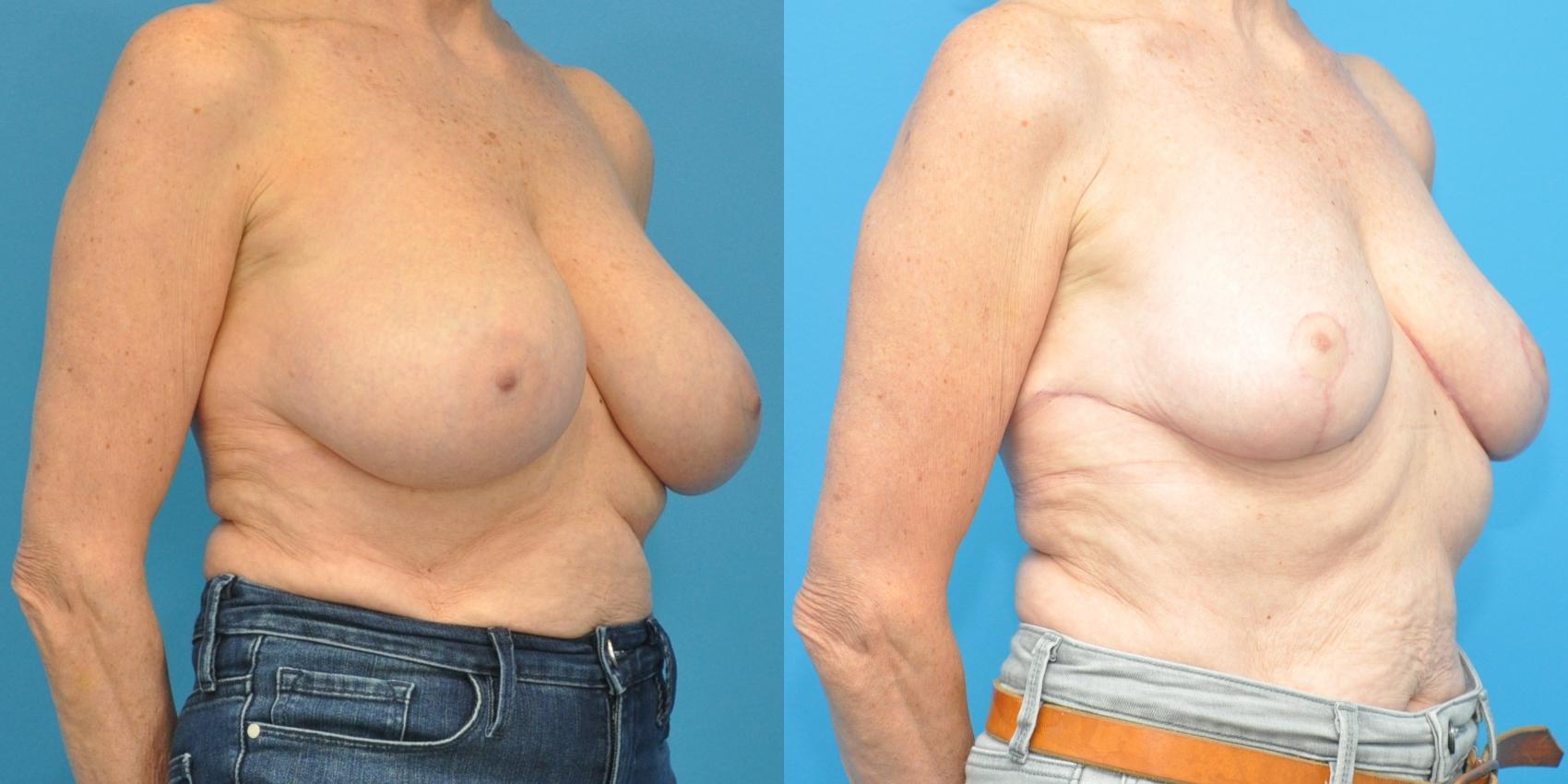 Before & After Breast Reduction Case 147 View #3 View in Northbrook, IL