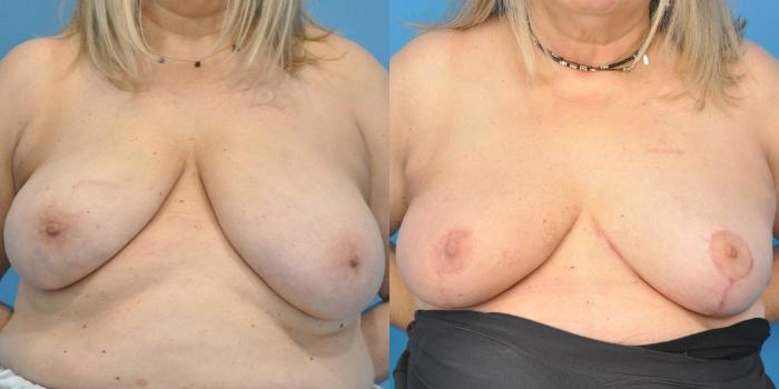 Before & After Breast Reduction Case 148 View #1 View in North Shore, IL
