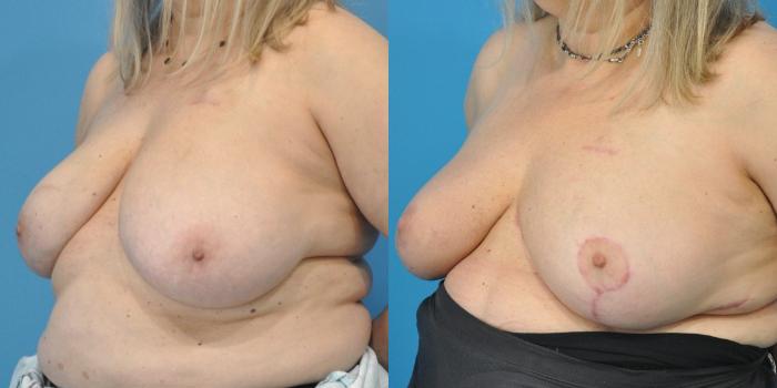 Before & After Breast Reduction Case 148 View #2 View in North Shore, IL