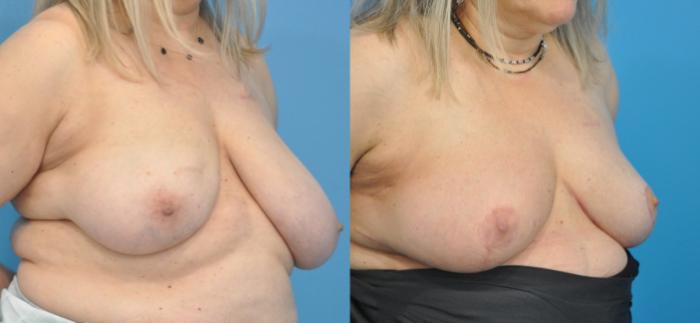 Before & After Breast Reduction Case 148 View #3 View in North Shore, IL
