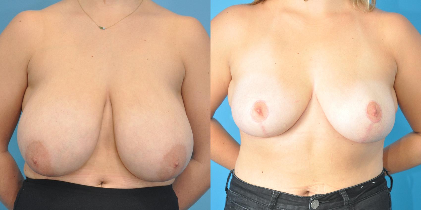 Before & After Breast Reduction Case 150 View #1 View in North Shore, IL