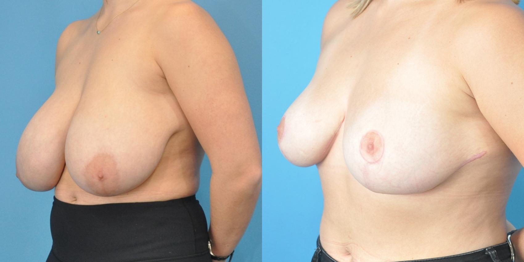 Before & After Breast Reduction Case 150 View #2 View in Northbrook, IL