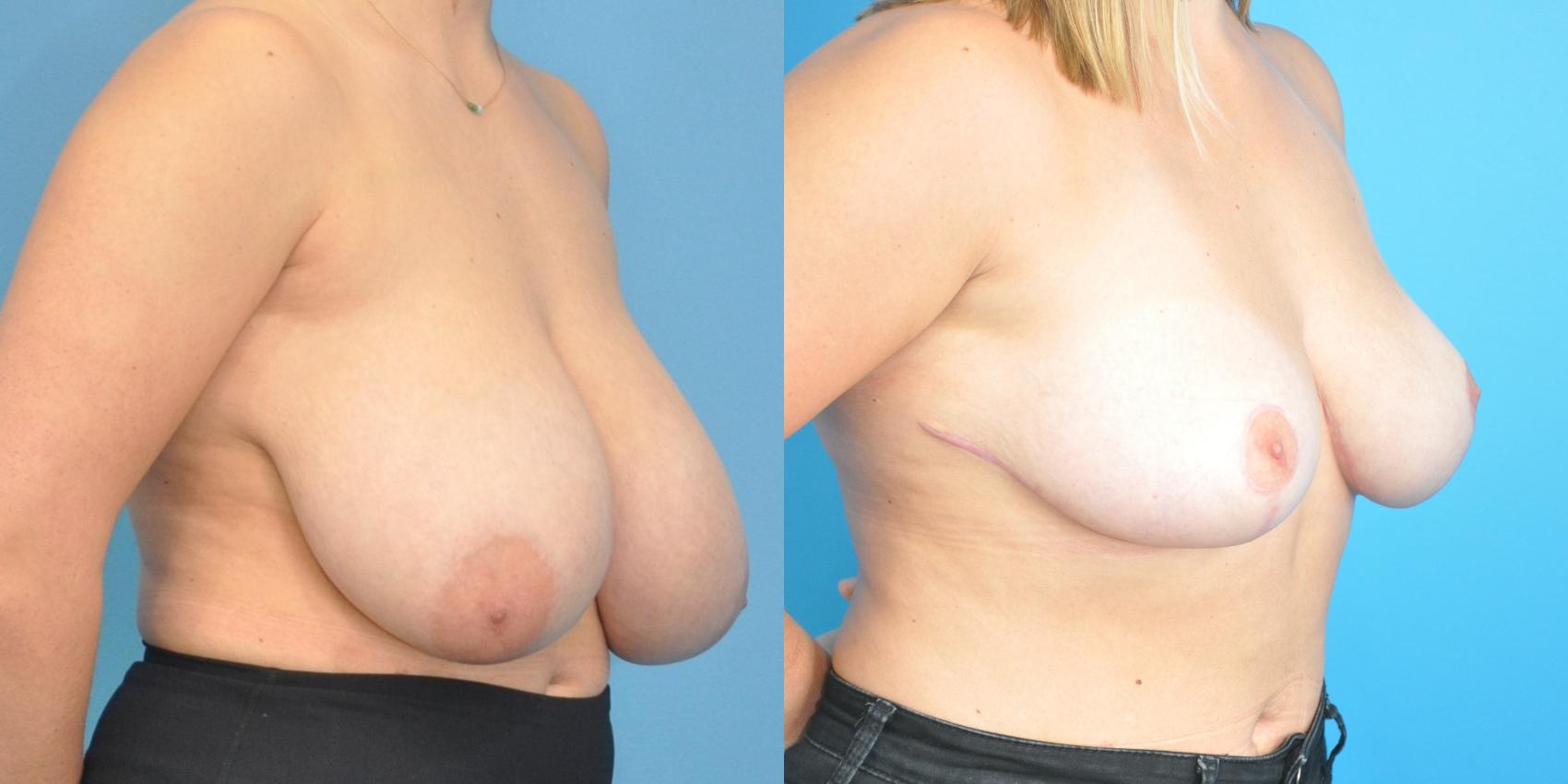 Before & After Breast Reduction Case 150 View #3 View in Northbrook, IL