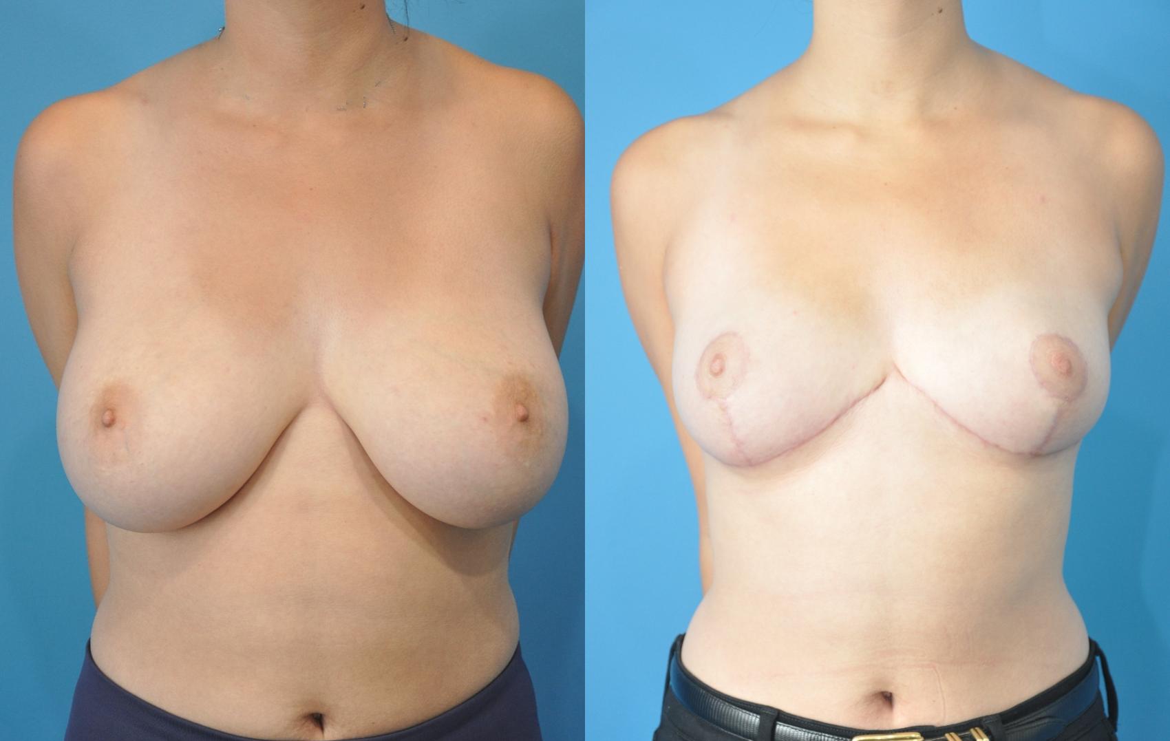 Before & After Breast Reduction Case 157 View #1 View in North Shore, IL
