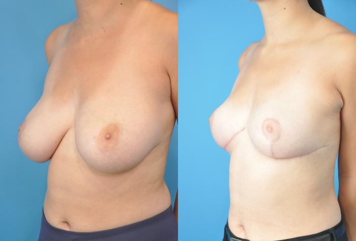 Before & After Breast Reduction Case 157 View #2 View in North Shore, IL