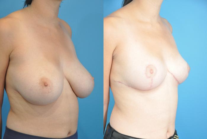 Before & After Breast Reduction Case 157 View #3 View in North Shore, IL