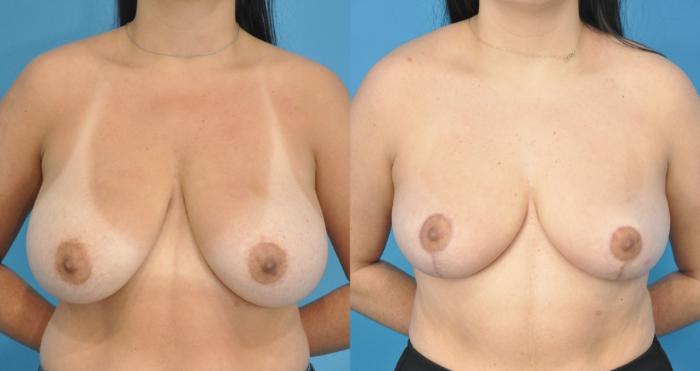 Before & After Breast Reduction Case 167 View #1 View in Northbrook, IL