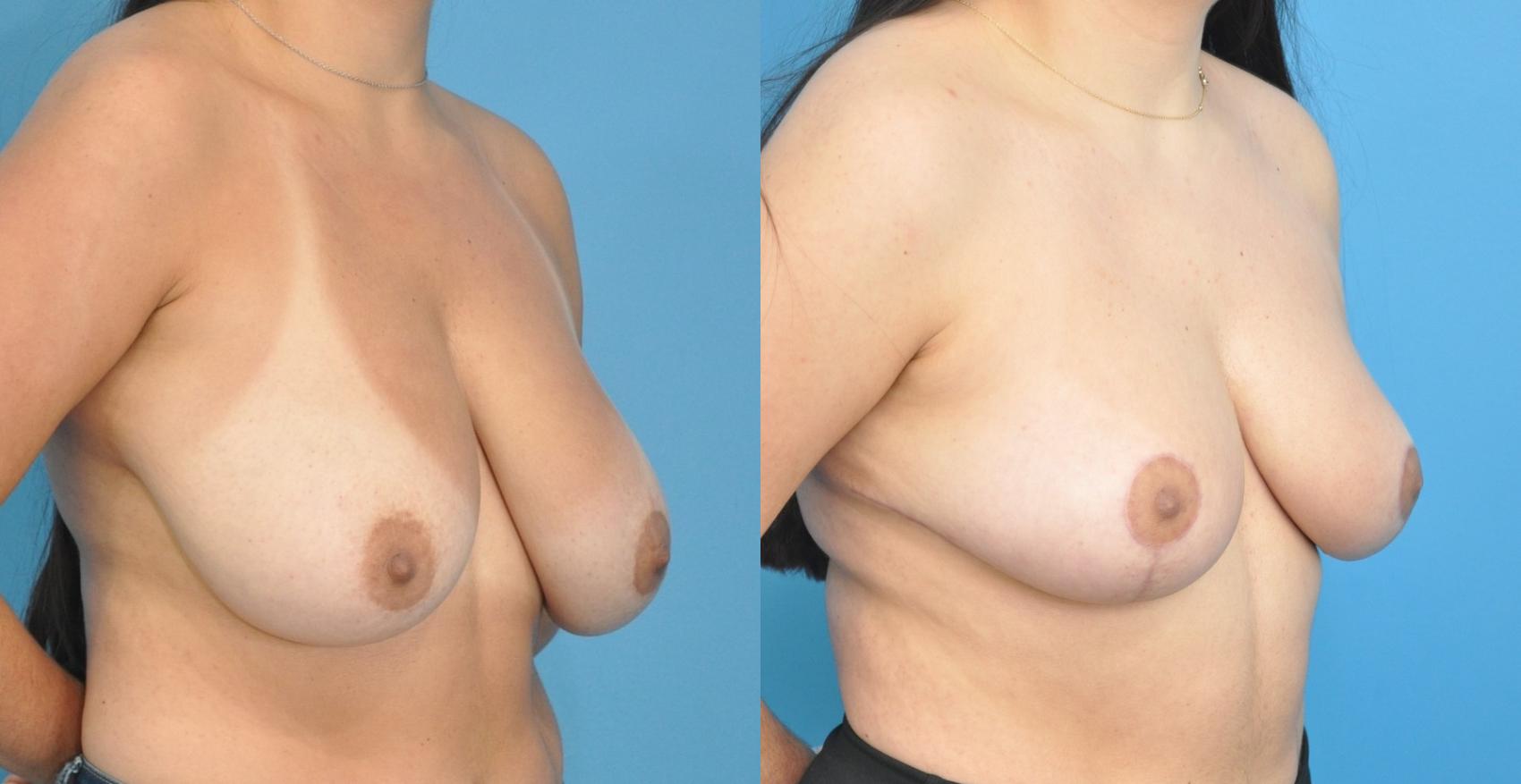 Before & After Breast Reduction Case 167 View #2 View in Northbrook, IL