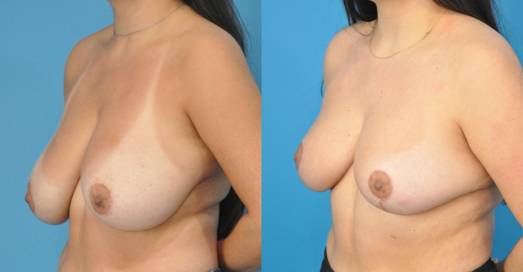 Before & After Breast Reduction Case 167 View #3 View in Northbrook, IL
