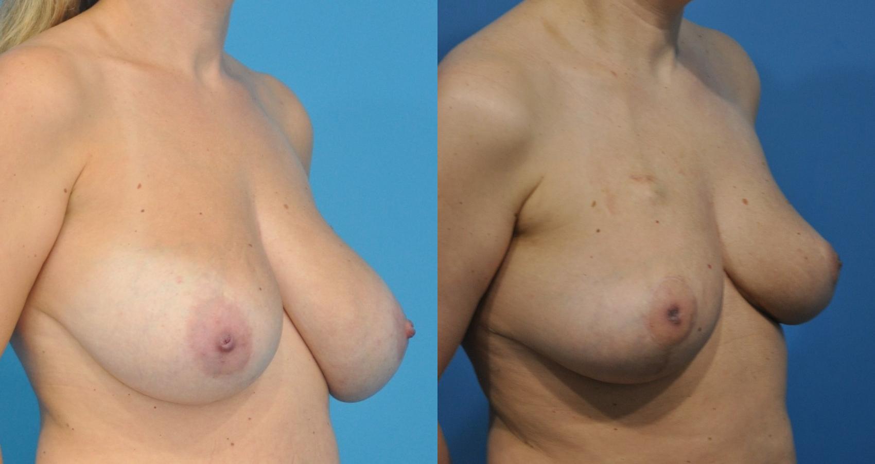 Before & After Breast Reduction Case 172 View #1 View in Northbrook, IL