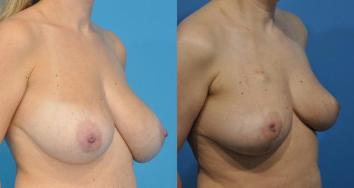 Before & After Breast Reduction Case 172 View #1 View in North Shore, IL