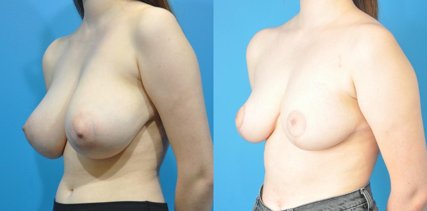 Before & After Breast Reduction Case 178 View #2 View in Northbrook, IL