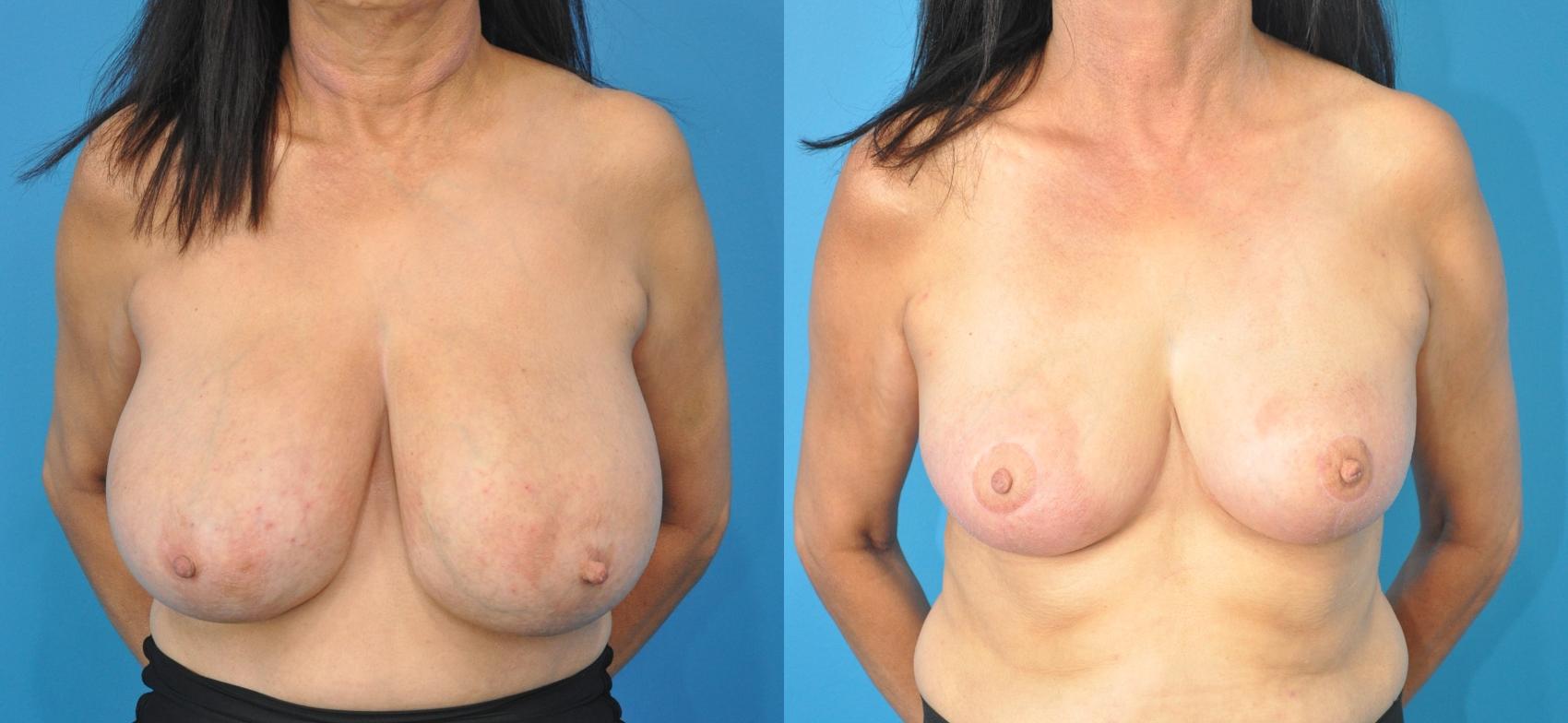 Before & After Breast Reduction Case 184 View #1 View in Northbrook, IL