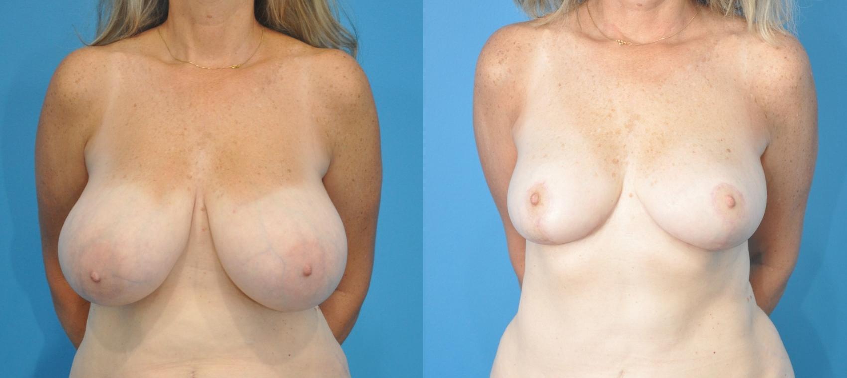 Before & After Breast Reduction Case 188 View #1 View in North Shore, IL