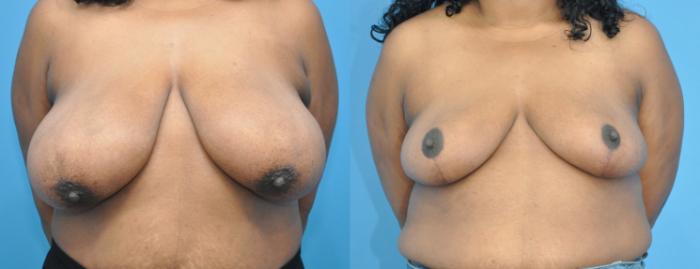 Before & After Breast Reduction Case 193 View #1 View in North Shore, IL