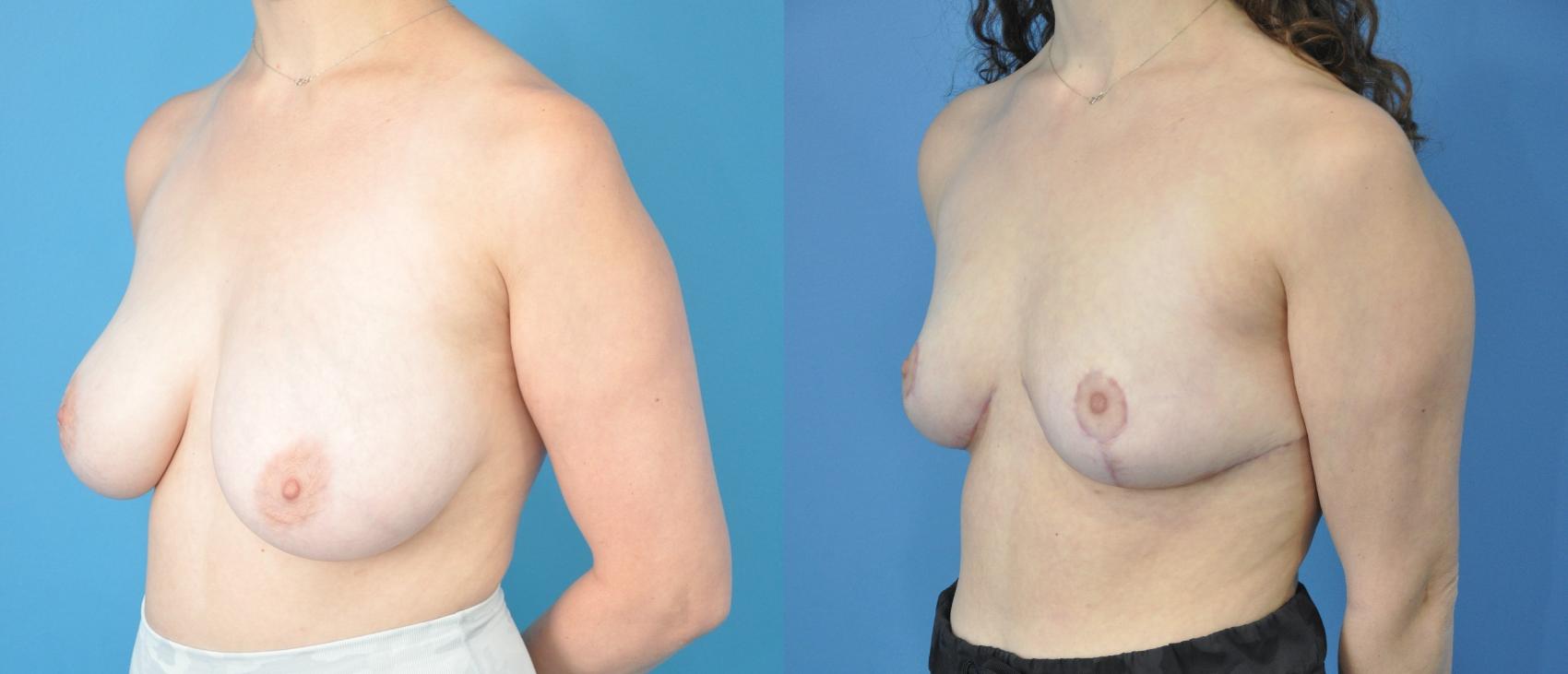 Before & After Breast Reduction Case 197 View #2 View in Northbrook, IL