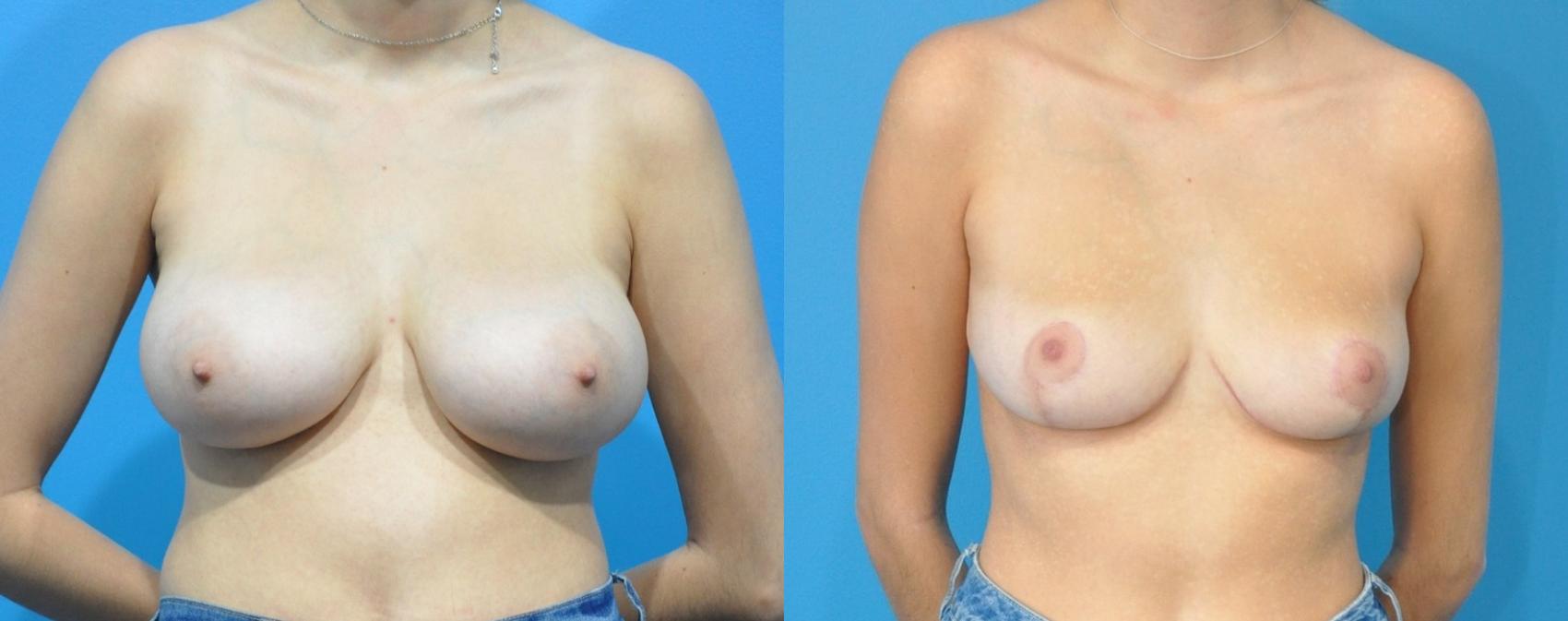 Before & After Breast Reduction Case 201 View #1 View in Northbrook, IL