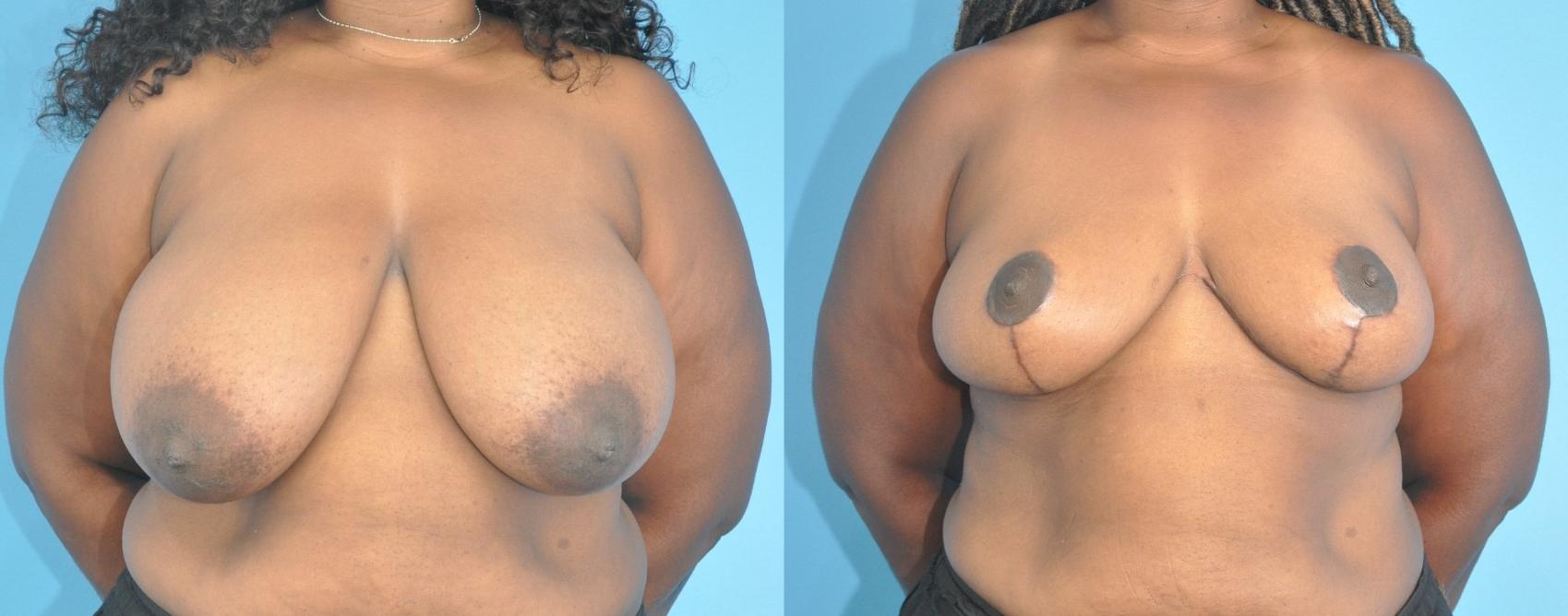Before & After Breast Reduction Case 202 View #1 View in North Shore, IL