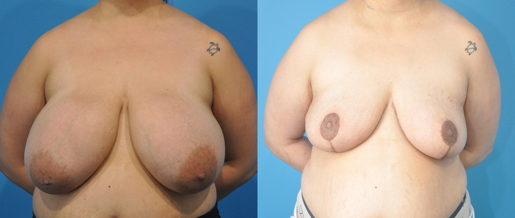 Before & After Breast Reduction Case 204 View #1 View in Northbrook, IL