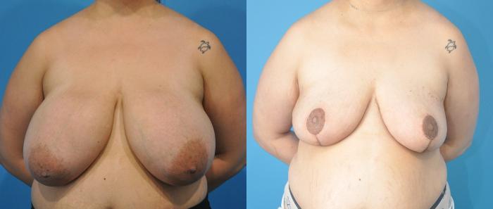 Before & After Breast Reduction Case 204 View #1 View in North Shore, IL