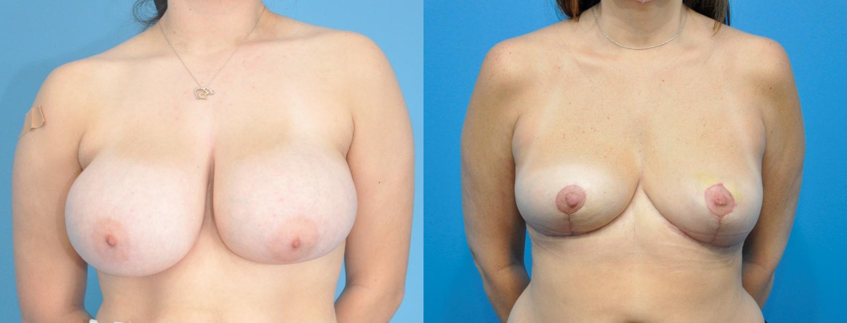 Before & After Breast Reduction Case 213 View #1 View in Northbrook, IL