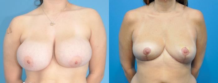 Before & After Breast Reduction Case 213 View #1 View in North Shore, IL