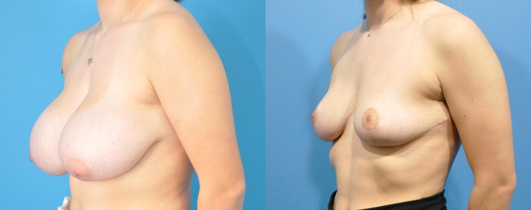 Before & After Breast Reduction Case 213 View #2 View in Northbrook, IL