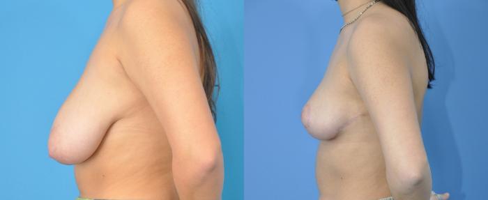 Before & After Breast Reduction Case 215 View #3 View in North Shore, IL