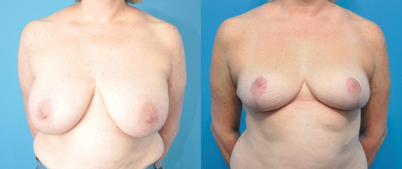Before & After Breast Reduction Case 218 View #1 View in North Shore, IL