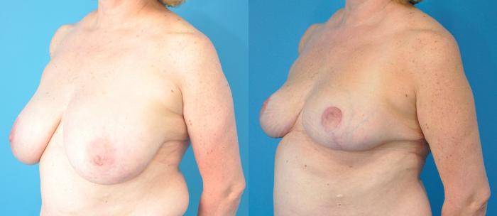 Before & After Breast Reduction Case 218 View #2 View in North Shore, IL