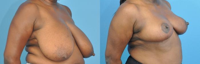 Before & After Breast Reduction Case 223 View #1 View in North Shore, IL