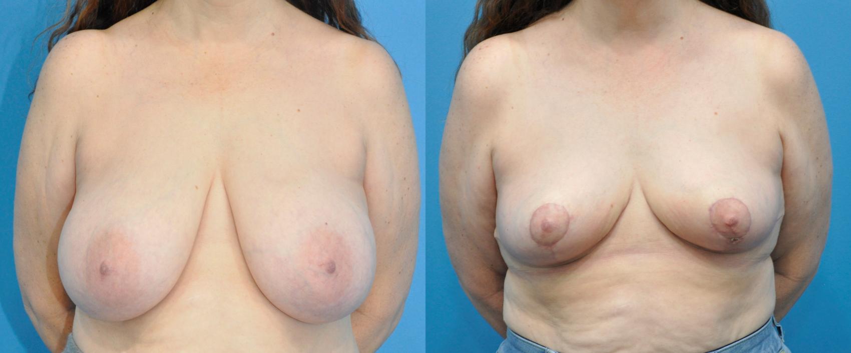Before & After Breast Reduction Case 225 View #1 View in Northbrook, IL