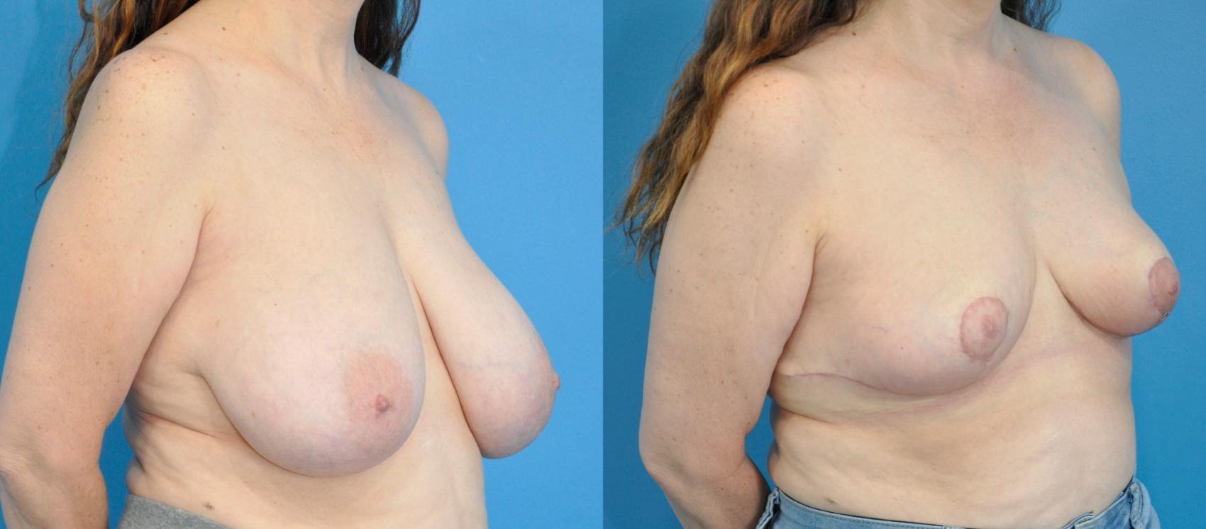 Before & After Breast Reduction Case 225 View #2 View in Northbrook, IL
